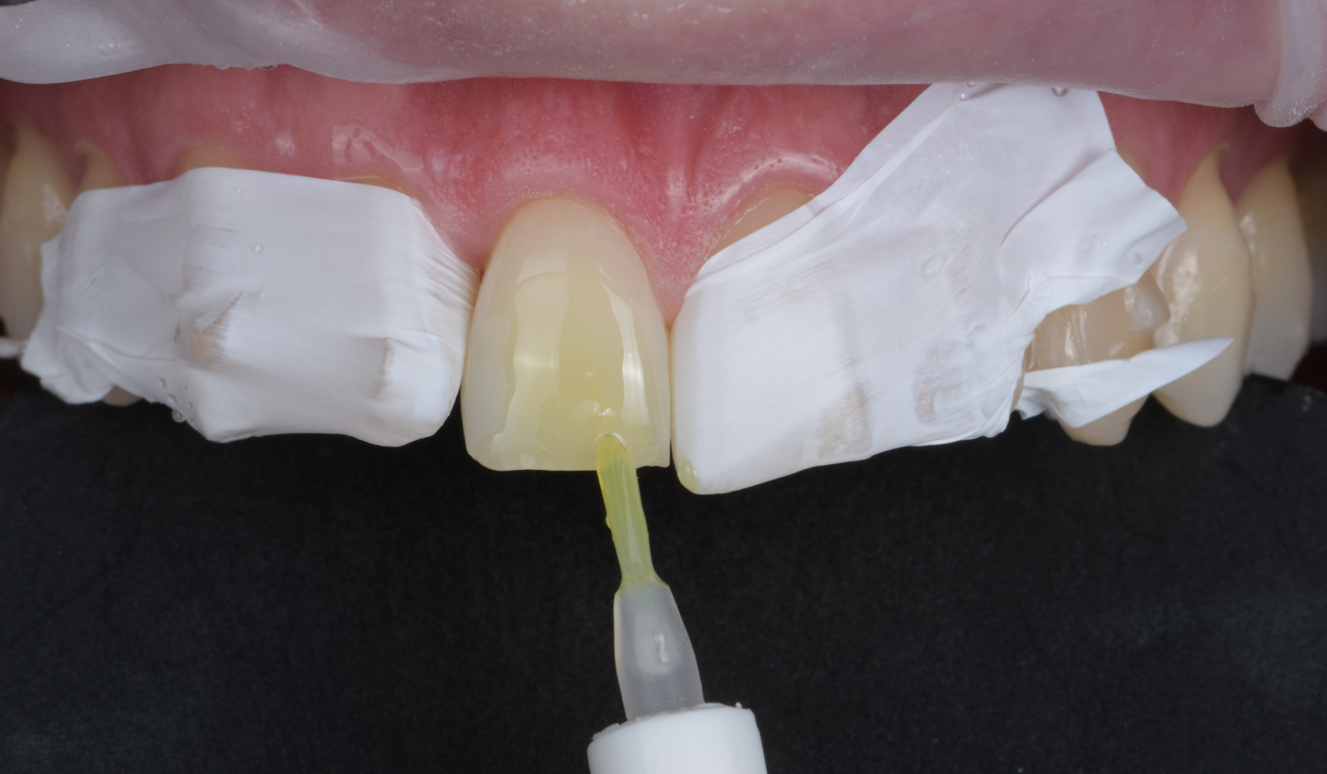 Use of a New Universal Flowable Composite